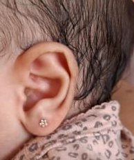 Orelha esquerda da mesma bebê, com lóbulo de tamanho diferente